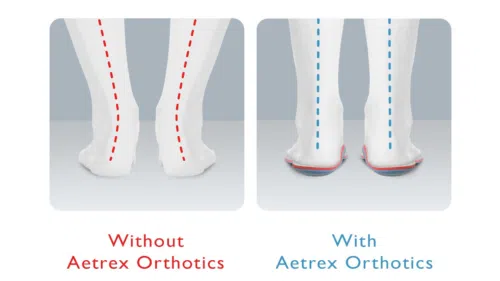 image of how people stand with and without orthotics